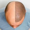 Où faire une tricopigmentation ?