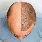 Où faire une tricopigmentation ?